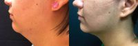 Kybella Patient shown 8 weeks after 2nd treatment