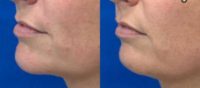 35-44 year old woman treated with Chin Fillers