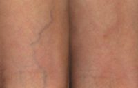 65-74 year old woman treated with Sclerotherapy