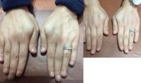 25-34 year old woman treated with Radiesse for her hands