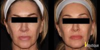 35-44 year old woman treated with Microneedling RF