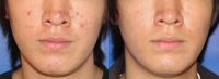Photodynamic Therapy for Acne