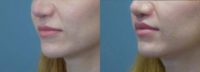 25-34 year old man treated with Modified Upper Lip Lift