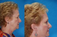 Face Lift with upper and lower blepharoplasty