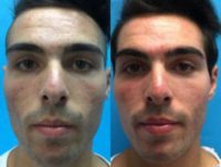 18-24 year old man treated with Microneedling