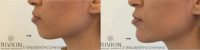 patient treated with Bellafill for chin enhancement
