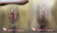 25-34 year old woman treated with Vaginal Rejuvenation