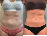45-54 year old woman treated with Emsculpt