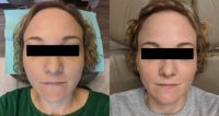 42 year old woman treated with one syringe of Voluma to the Midface and Cheekbone