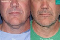 55-64 year old man treated with Chin Liposuction