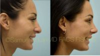 27 year old woman treated with Rhinoplasty