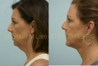 45-54 year old woman treated with Chin Implant