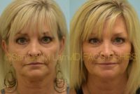 59 year old woman treated with Injectable Fillers