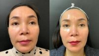 25-34 year old woman treated with Enlighten