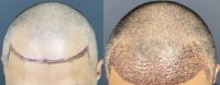 35-44 year old man treated with ARTAS Robotic Hair Transplant