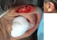 55-64 year old man treated with Mohs Surgery