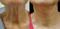 65-74 year old woman treated with Ultherapy