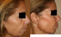 Liquid Face Lift with Juvederm