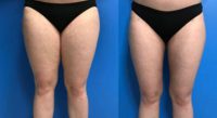 25-34 year old woman treated with Smart Lipo