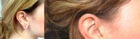 Gauged earlobe repair