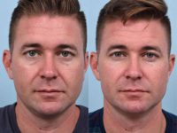 34 year old man treated with Liquid Facelift in the office.