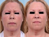 53 year old woman treated facial wrinkles with Botox while maintaining full movement.