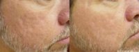 45-54 year old man treated with Acne Scars Treatment
