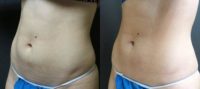 18-24 year old woman treated with CoolSculpting