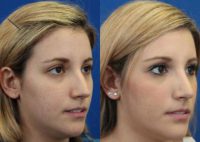 18-24 year old woman treated with Rhinoplasty and setoplasty to reduce her dorsal hump.