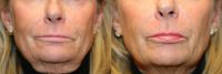 61 year old woman treated with Juvederm