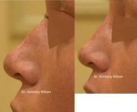 18-24 year old woman treated with Non Surgical Nose Job (liquid rhinoplasty)