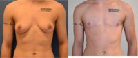 18-24 year old man treated with FTM Chest Masculinization Surgery