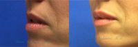 35-44 year old woman treated with Juvederm for Lip Augmentation