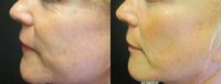 55-64 year old woman treated with Microneedling