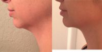 35-44 year old female treated with Kybella