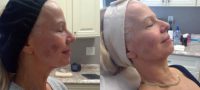 55-64 year old woman treated with PiQo4 Laser Treatment