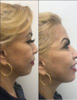55-64 year old woman treated with Radiesse