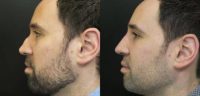 25-34 year old man treated with Non Surgical Nose Job