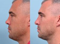 39 year old man treated with Revision Rhinoplasty with Rib grafting.