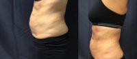 45-54 year old woman treated with SculpSure
