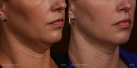 35-44 year old woman treated with Kybella and CoolSculpting