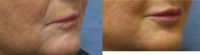 55-64 year old woman treated with Juvederm and Laser