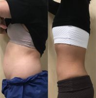 25-34 year old woman treated with Emsculpt