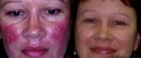 45-54 year old woman treated with Rosacea Treatment