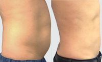 45-54 year old male treated with Tummy Tuck