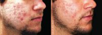 25-34 year old man treated with Smoothbeam Laser