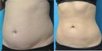18-24 year old woman treated with Fat Melting Laser Treatment