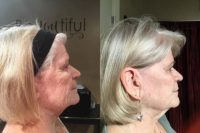 65-74 year old woman treated with Microneedling
