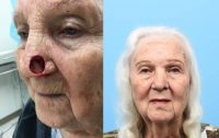 75 and up year old woman treated with Facial Reconstructive Surgery