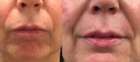 55-64 year old woman treated with Volbella Lip Filler
